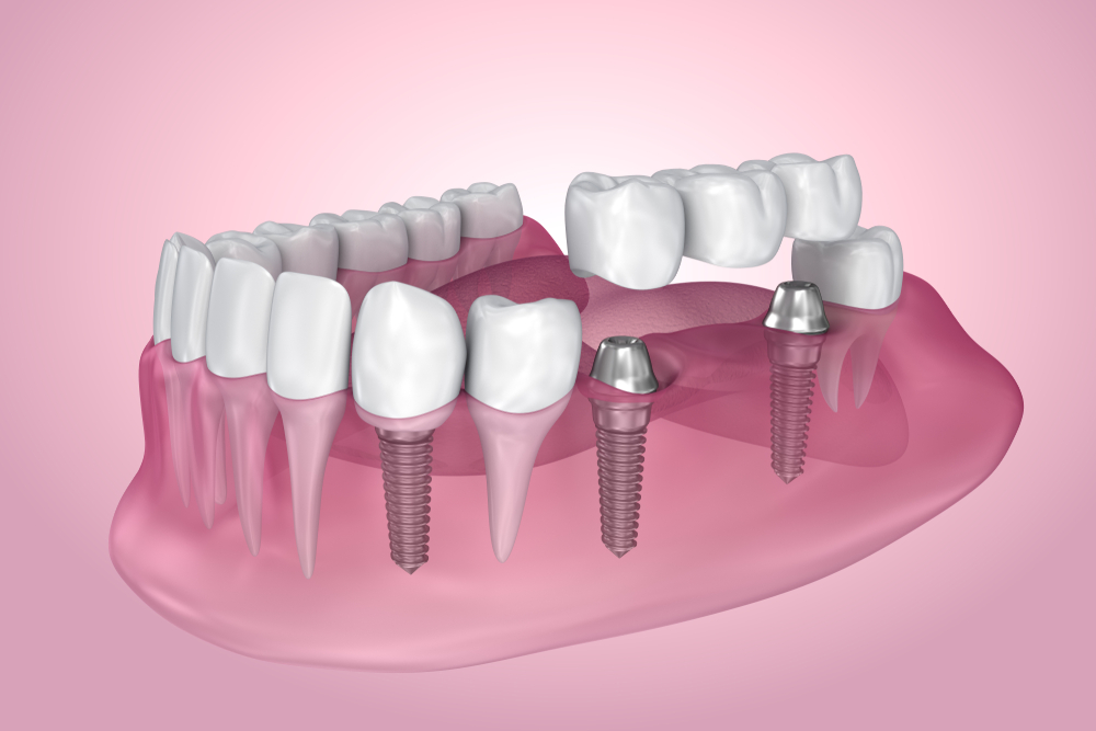 Dental Treatments 38