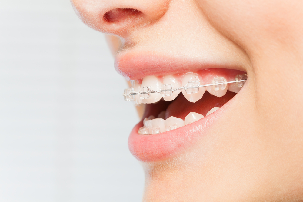 Orthodontics 14 Orthodontics 14